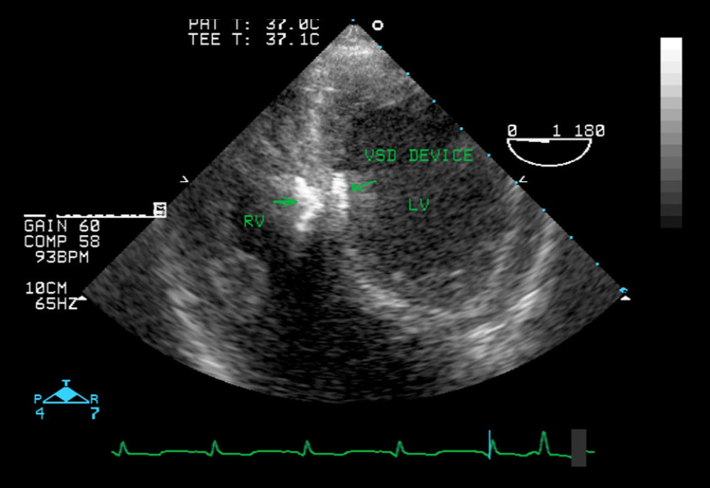 American Journal of Case Reports Simultaneous Transcatheter Closure