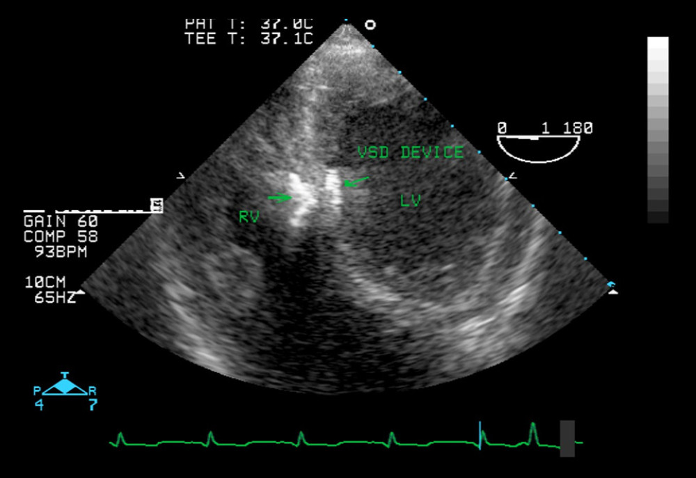 intraoperative transesophageal echocardiogram after VSD device closure. The image captures the VSD closure device in place between the left ventricle (LV) and right ventricle (RV), with no residual shunt observed. This echocardiographic view confirms the proper post-procedure positioning and function of the implanted device.