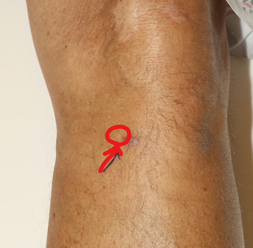 Picture of the skin lesion at initial presentation. The arrow points at the tiny patch of hypopigmented skin, also circled in red.