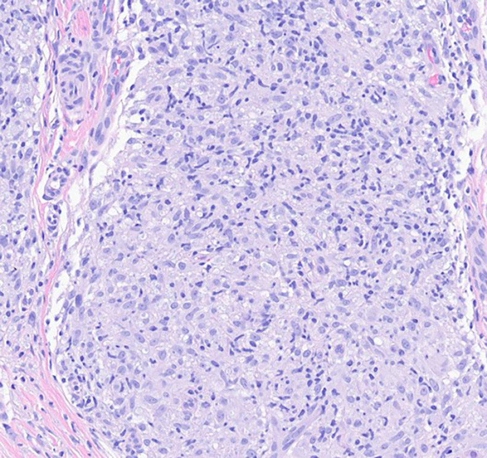 The granulomas are composed of macrophages with greyish cytoplasm, variable foamy change (“Virchow cells”) and varying numbers of large vacuoles (hematoxylin and eosin, 40×).