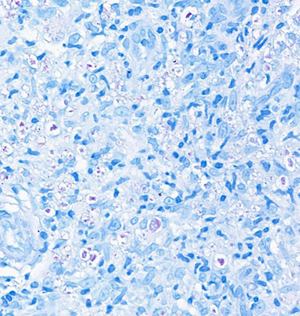 Large numbers of acid-fast bacilli are present solitarily and in clusters (“globli”) (Fite-Franco stain, 80×).