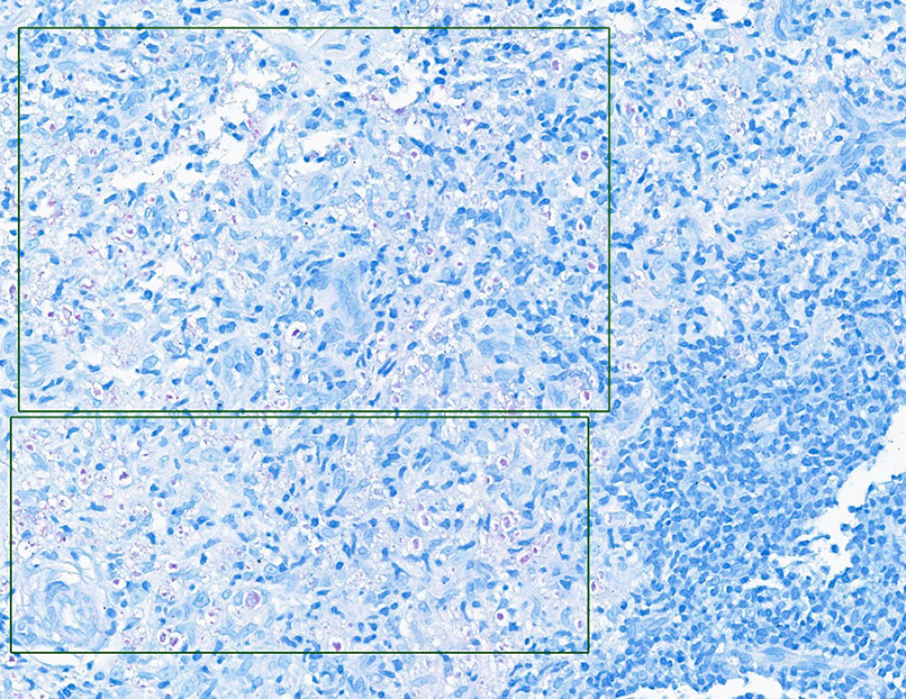 Negative AFB stain showing no acid-fast bacilli.