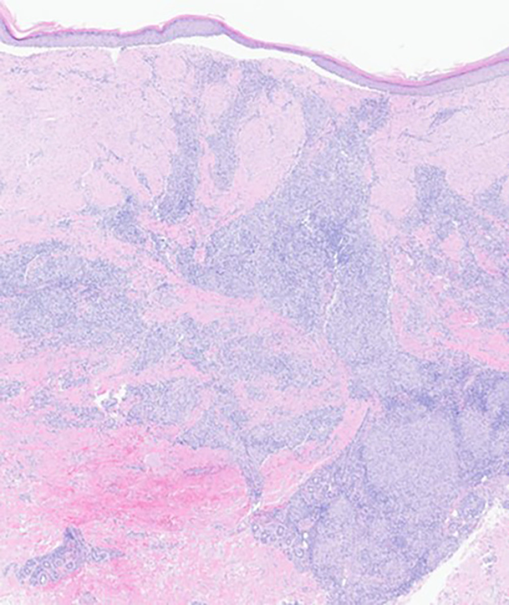 Prominent pan-dermal nodular granulomatous infiltrate through the dermis and involving skin adnexa with minimal lymphocytic inflammation. An incidental scar (*) is present superficially from a prior biopsy (hematoxylin and eosin, 4×).