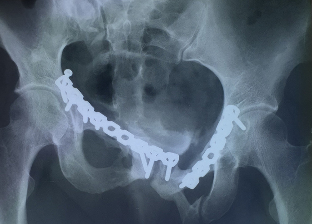 Past postoperative X-ray after open reduction and internal fixation of the pelvic ring with surgical plates and screws.