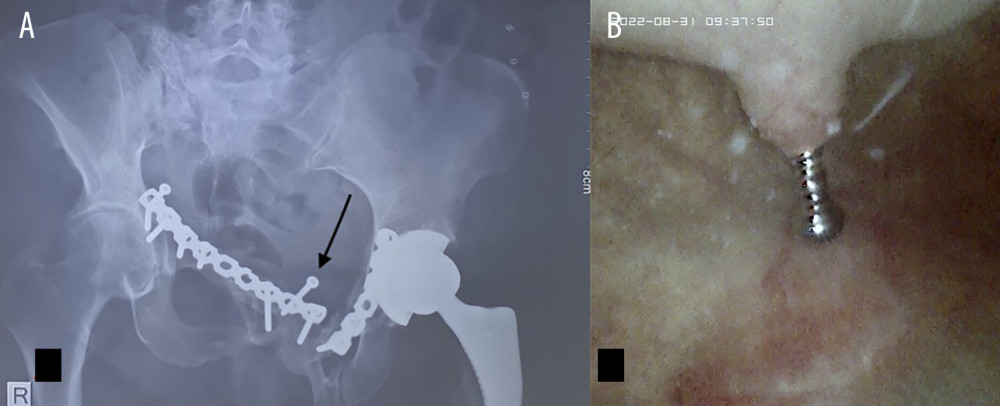 Current preoperative images. (A) The X-ray shows the loose surgical screw of the pubic bone’s cement (black arrow), which is the main difference with the previous image. (B) Cystoscopy revealed the head of a screw protruding into the bladder wall, which consequently caused the symptoms.