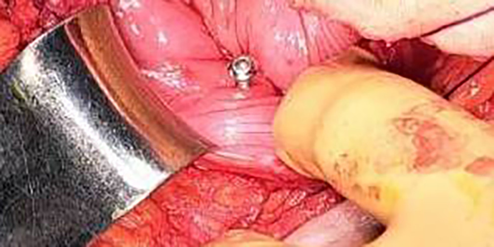 The screw was detected and removed after cystotomy during an open surgery procedure.