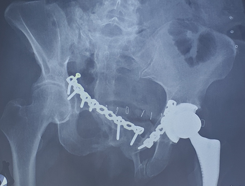 A postoperative X-ray image. The absence of the previously loose screw proves that this was the protruding surgical screw head in the bladder.