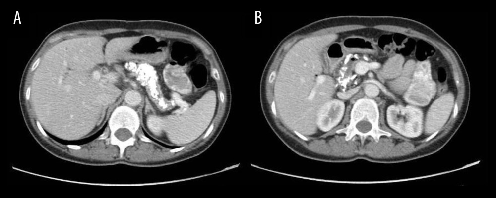Radiologic features: diffuse coarse calcifications throughout the duct and parenchyma of the pancreas with dilated main duct (A), extending to the head without an inflammatory mass (B).