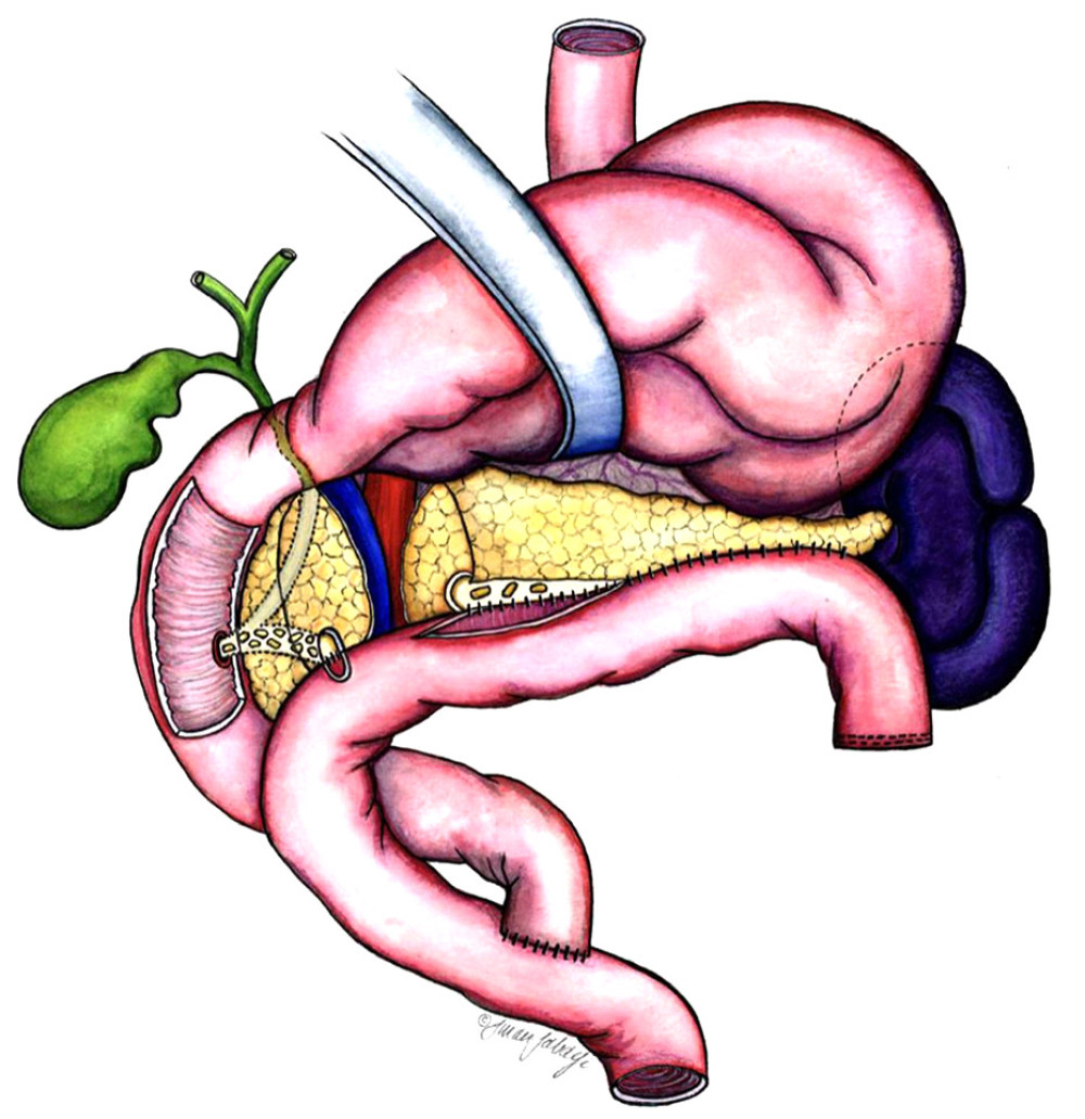 Transection of the pancreas at the neck, exposing the cut ends of the main duct in the head and body. A Roux limb fashioned for anastomoses to the pancreatic duct in the head and to the longitudinal ductotomy in the body and tail.