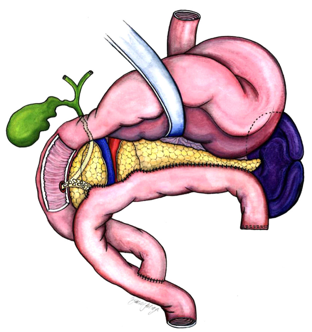 The combined Roux-en-Y proximal end-to-side of the head and distal longitudinal pancreatojejunostomy of the body and tail of the pancreas.