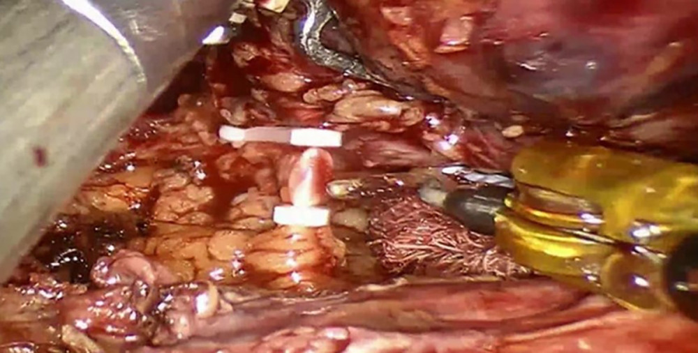 Intraoperative appearance by robotic technique of the obturator nerve schwannoma. Ligation of the pedicle of the left obturator nerve.