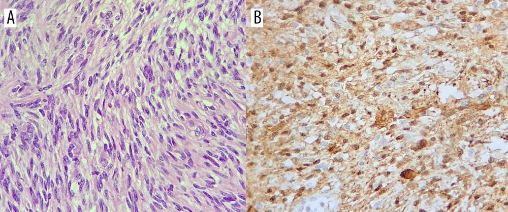 (A, B) Photomicrographs of the diagnostic histopathology of the resected benign schwannoma of the obturator nerve in a 51-year-old woman. Figures A and B show the typical features of a cellular schwannoma consisting of benign spindle cells in mucinous and edematous stroma, consistent with Antoni A areas. Pallisading spindle cells are present, consistent with Verocay bodies. There is no evidence of malignancy. Hematoxylin and eosin. Magnification ×40.