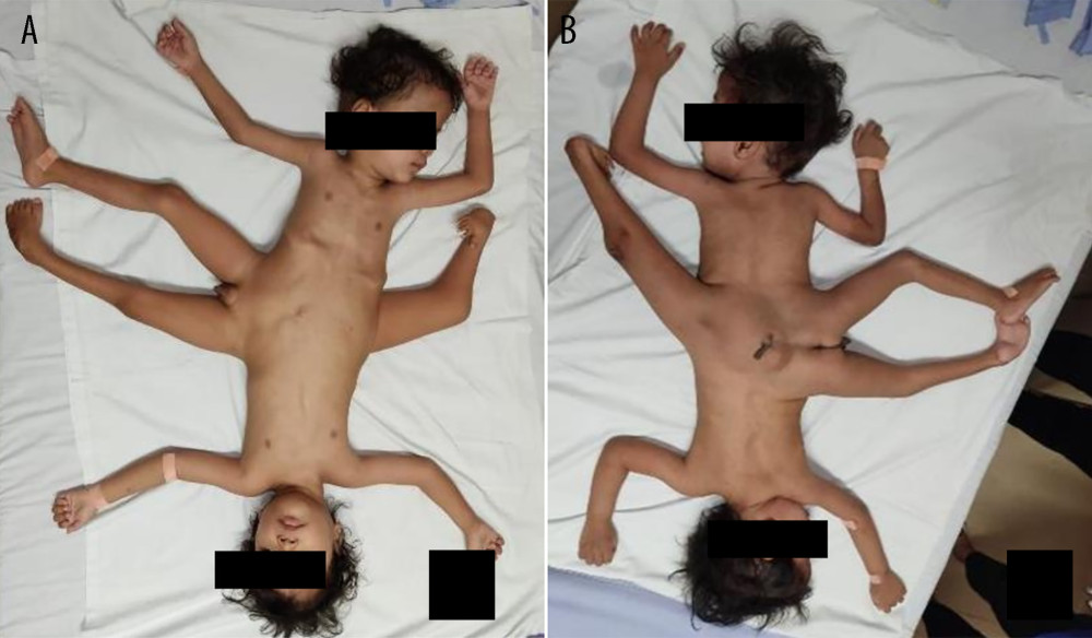 Clinical presentation of 3-year-old ischiopagus tripus conjoined twins. (A) anterior view; (B) posterior view.