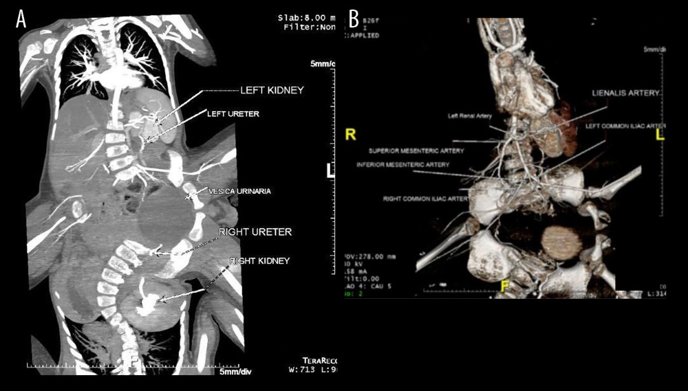 Angiography computed tomography scan of the patient. (A) Left kidney hypoplasia in twin I, and left kidney agenesis in conjoined twin II. (B) Left renal artery appears smaller than the right renal artery.