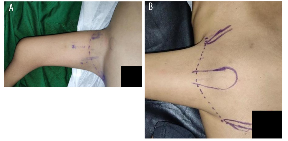 Incision design marking on (A) anterior and (B) posterior segment.