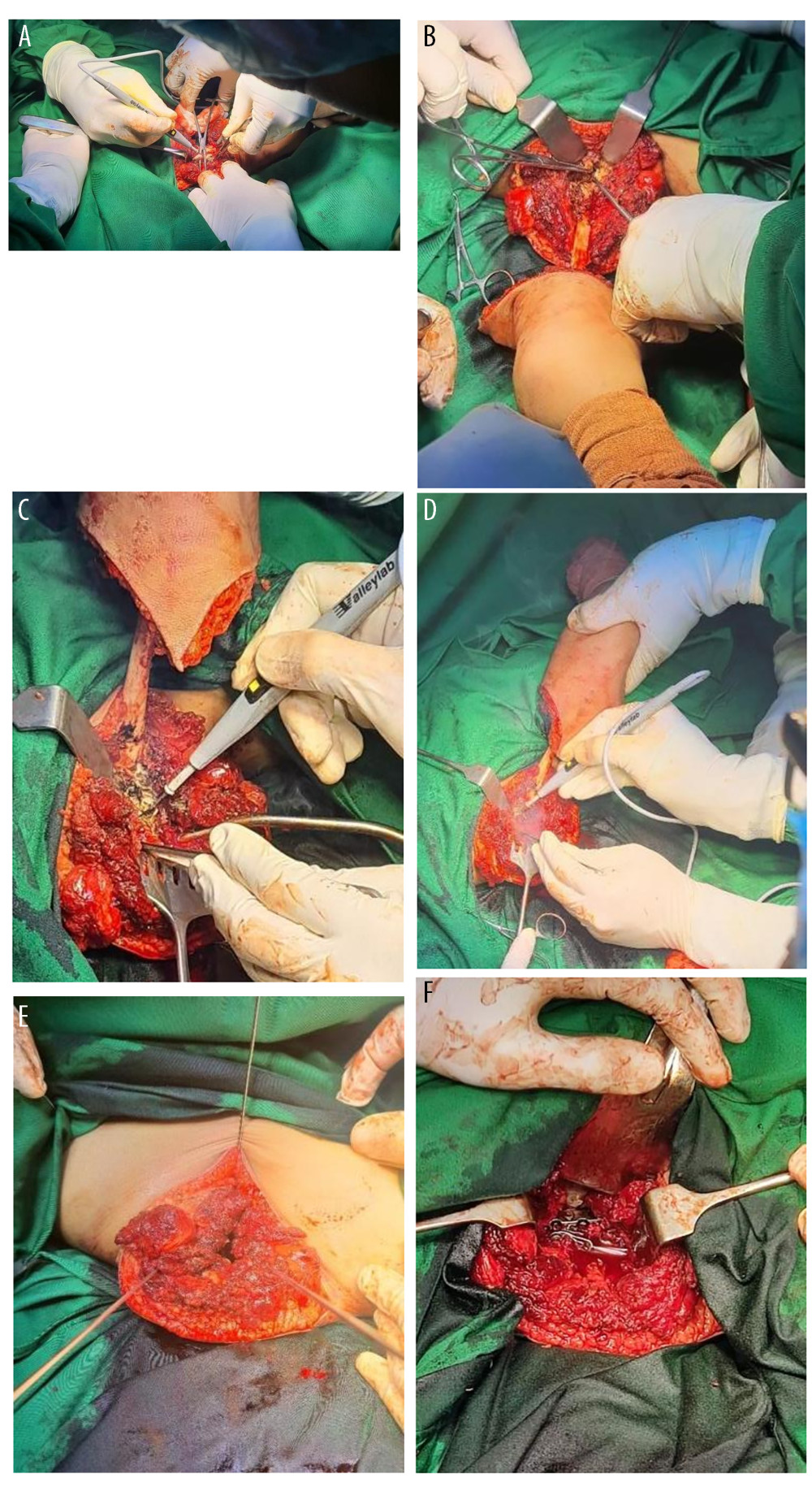 (A–F) Intra-operative views of non-functioning third limb disarticulation.