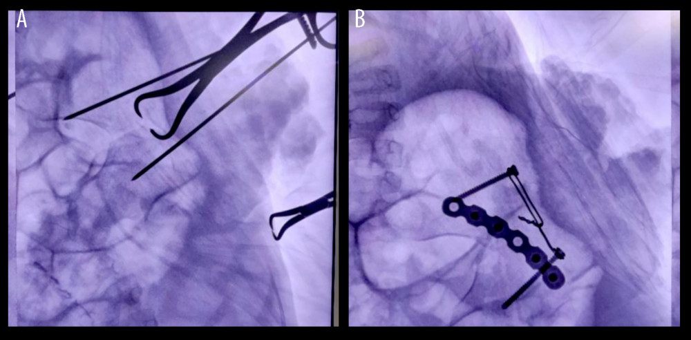 (A) Temporary K-wire marking and (B) internal fixation using curve locking reconstruction plate.