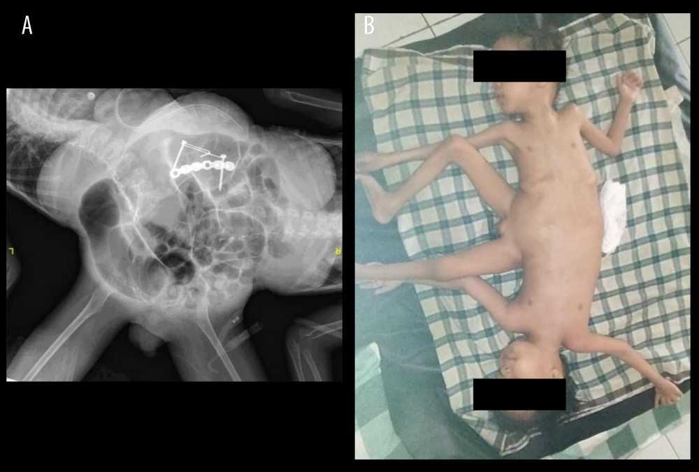 Postoperative (A) X-ray and (B) clinical condition.