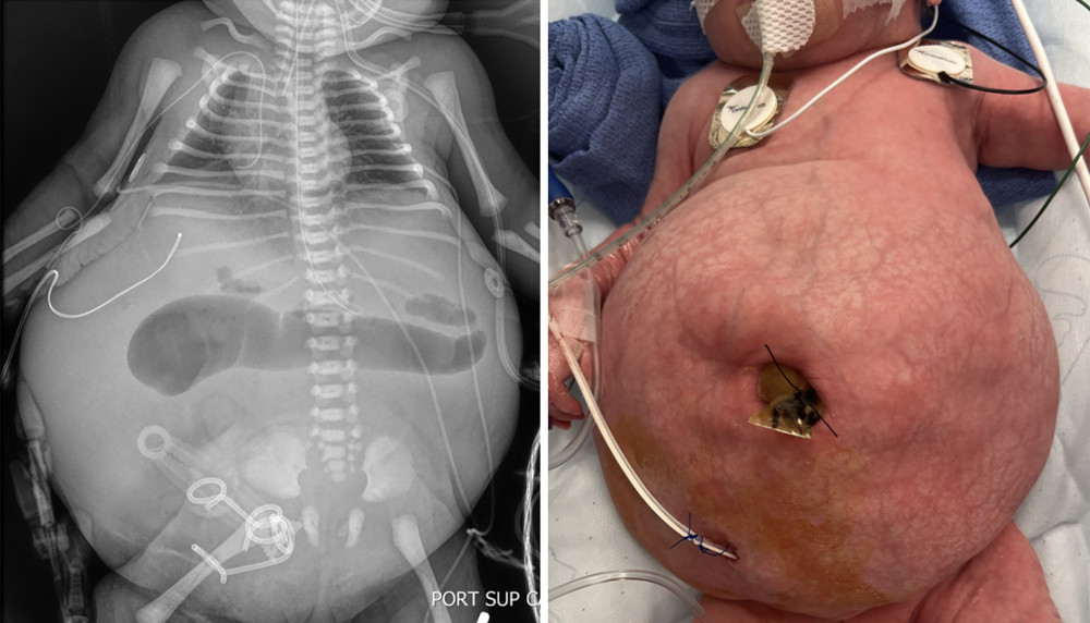 Preoperative abdominal radiograph demonstrating distended, gaseous loop of bowel in the midabdomen with a relative paucity of gas throughout the rest of the abdomen alongside a photograph taken at bedside.