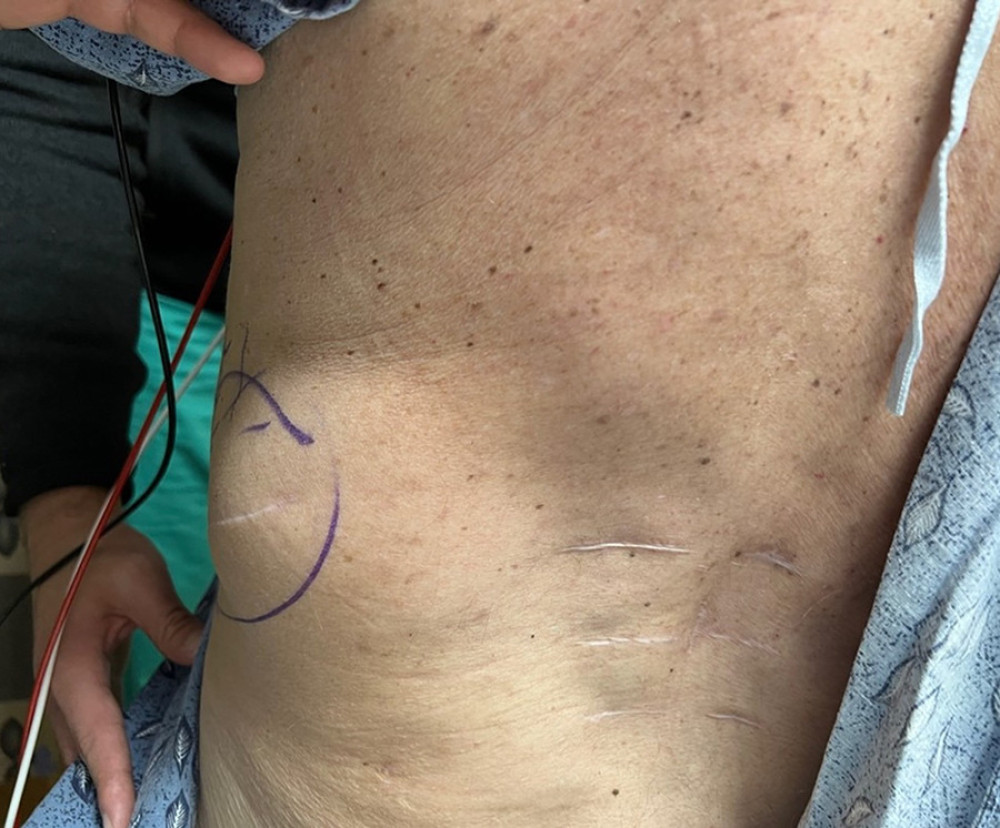 Preoperative physical examination image of patient’s back with him standing.