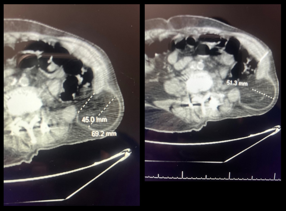 Preoperative computed tomography scans showing the hernia, with dimensions.
