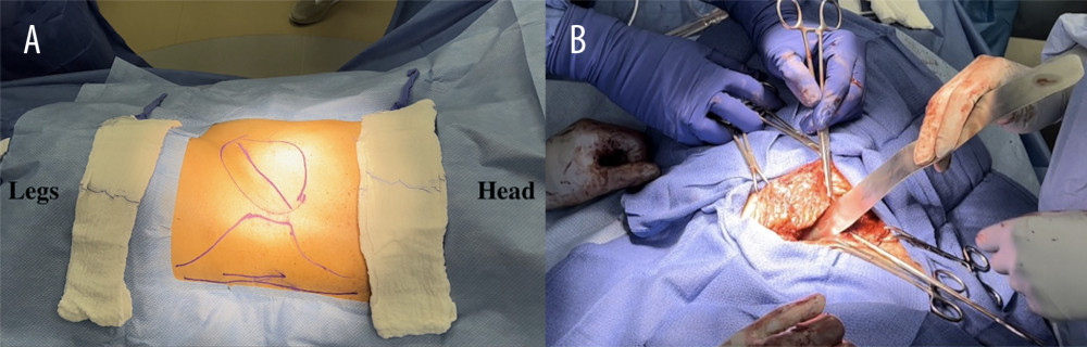 (A) Patient in right lateral decubitus, exposing left flank. The words “head” and “legs” are used for visual orientation. The word “head” located at the right side of the image is used to describe the proximal portion of the patient’s body, and the word “legs” is used to describe the distal portion of the patient’s body. In the image, pre-incision markings are used to outline the hernia defect. (B) Picture depicting intraoperative hernia defect.