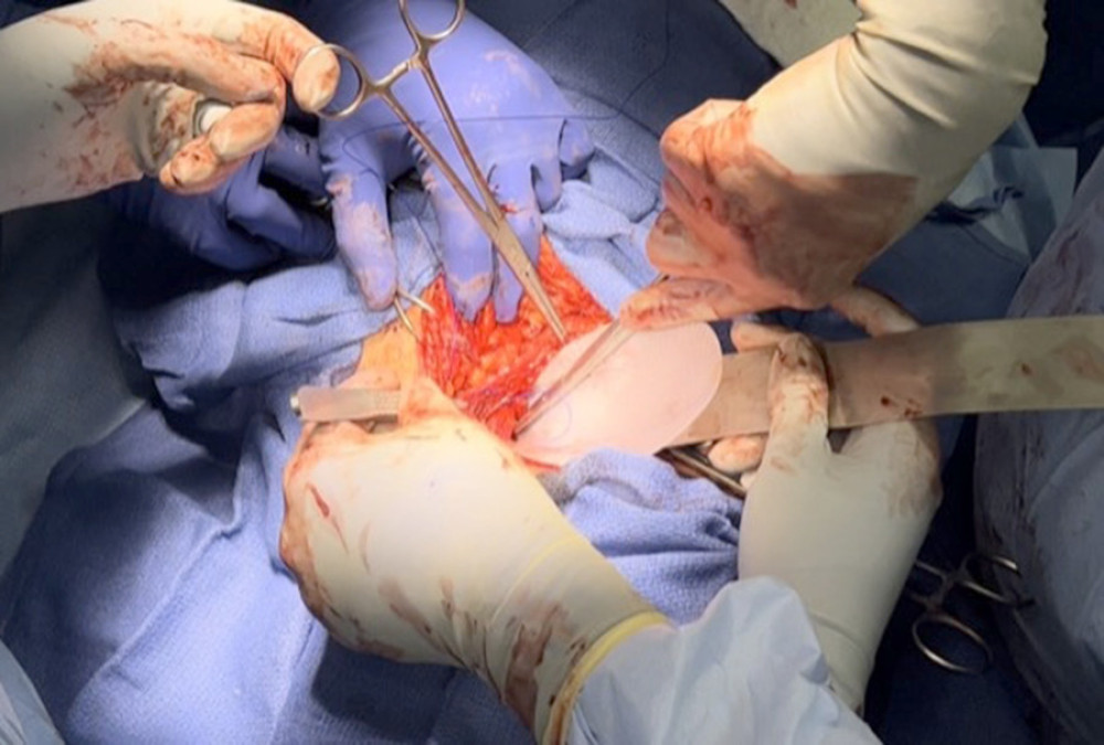 Intraoperative mesh placement image.