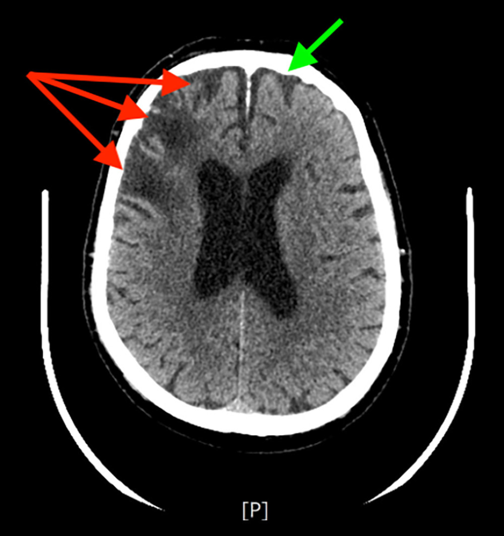 Axial view of non-contrast computer tomography scan of the brain revealing chronic encephalomalacia in the right frontal (red arrows) and left frontal lobes (green arrow).
