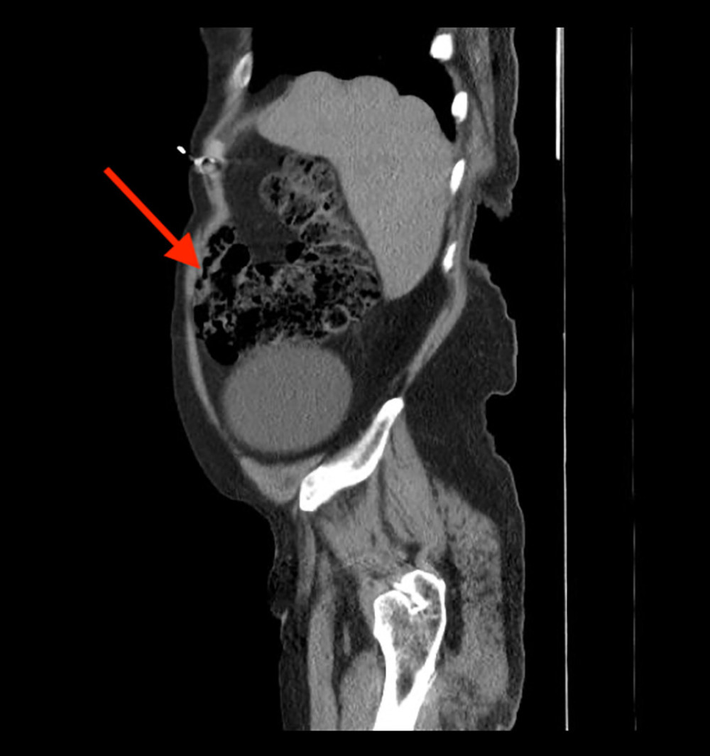 Sagittal view of computer tomography scan of the abdomen revealing moderate to large volume stool burden in the cecum (red arrow).