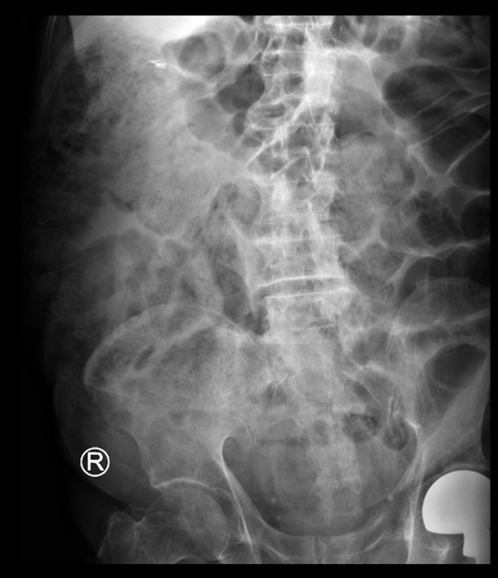Anterior-posterior view of abdominal X-ray revealing a heavy stool burden with a non-obstructive bowel gas pattern.
