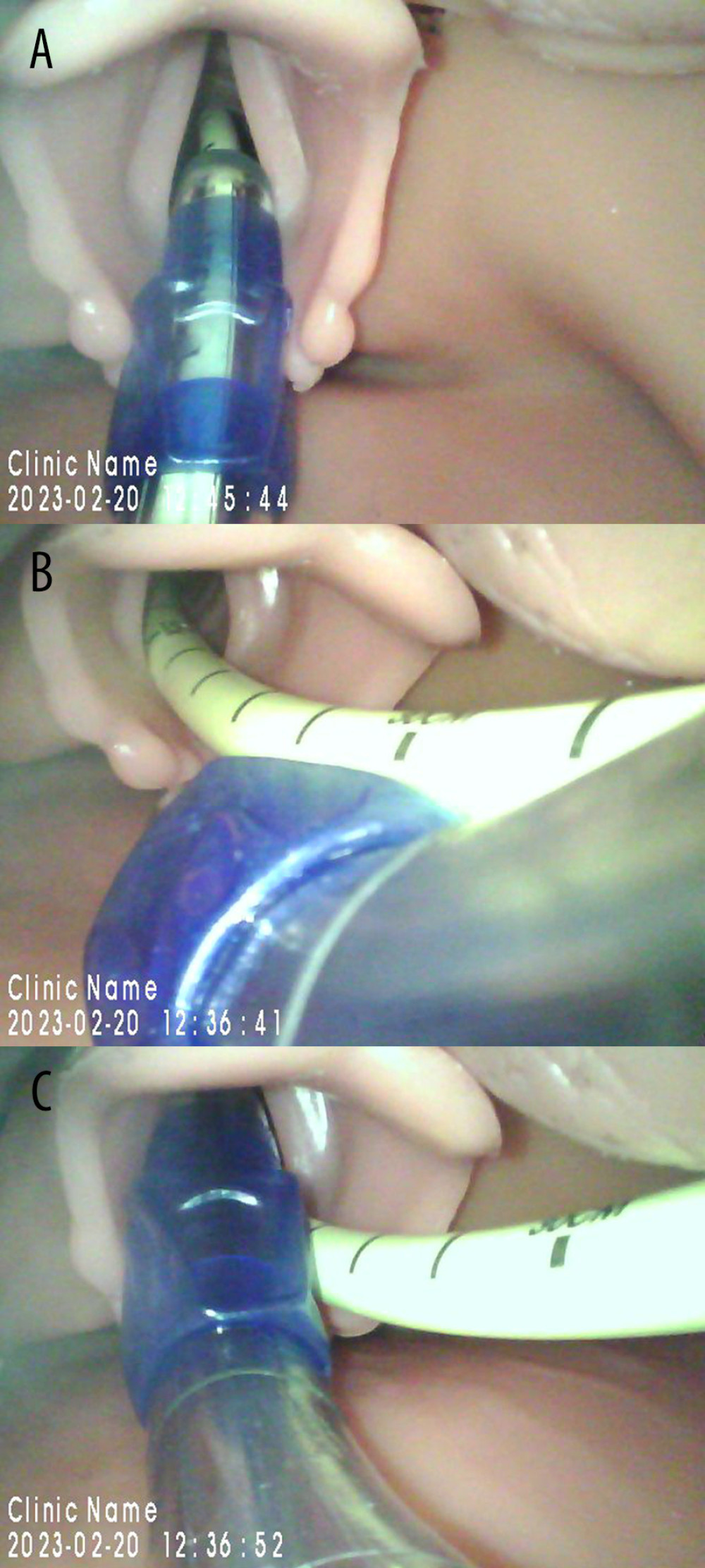 (A–C) Reproduction of the double-lumen tube along the Cook®AEC on a model. (A) Failed exchange due to the flexibility of the AEC. (B) Cook®AEC in place to allow oxygenation. (C) Intubation along the AEC left in place.