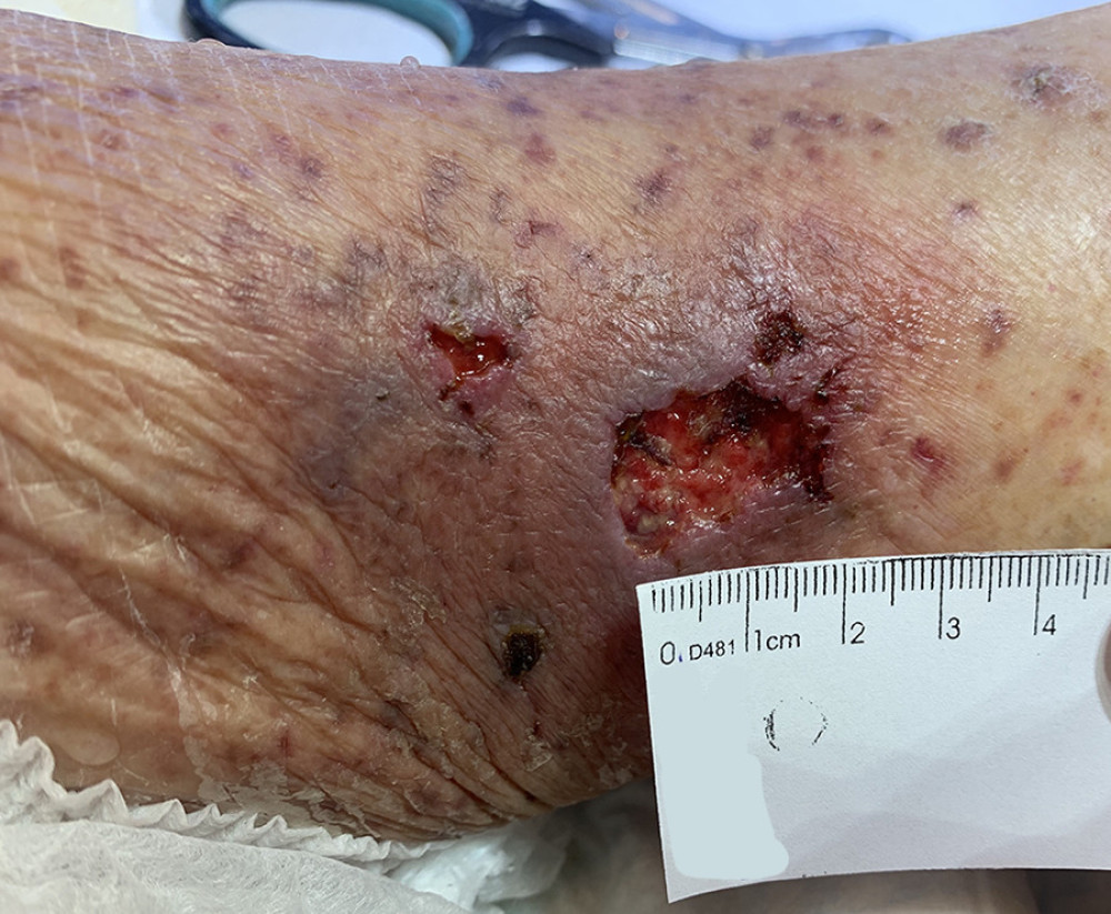Initial ulcerated lesions on left lower limb.
