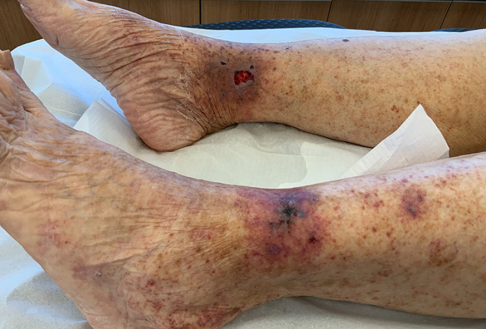 Scattered blistered, blackened, and ulcerated lesions on lower limbs.