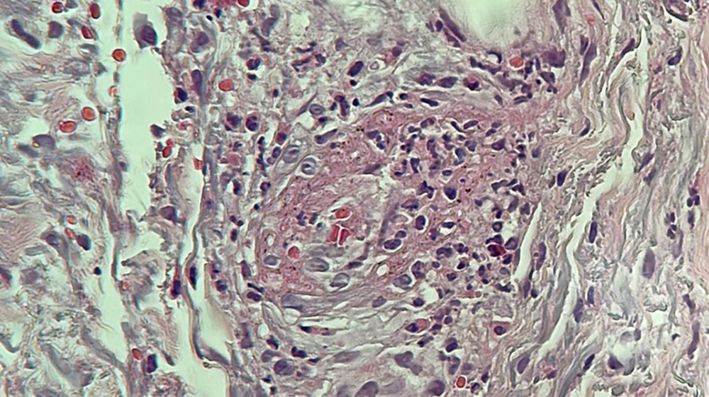 Histopathological analysis indicating leukocytoclastic vasculitis: angiocentric infiltration containing lymphocytes, histiocytes, and neutrophils, mild red blood cell extravasation, and fibrinoid necrosis in vessel walls.