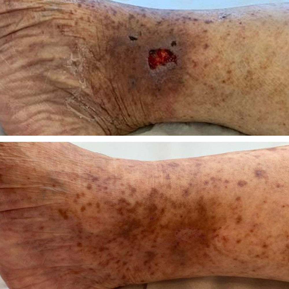 Photographic comparison: Above, initial ulcerative lesions, and below, only post-inflammatory hyperchromia without scar changes.
