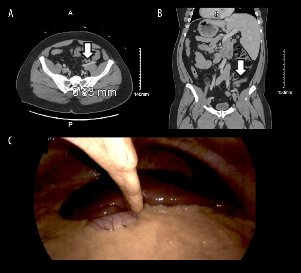 Axial (A) and coronal (B) view computed tomography images showing situs inversus totalis, with enlarged left-sided appendix (white arrows). Laparoscopic image (C) showing left-sided liver, confirming situs inversus totalis.
