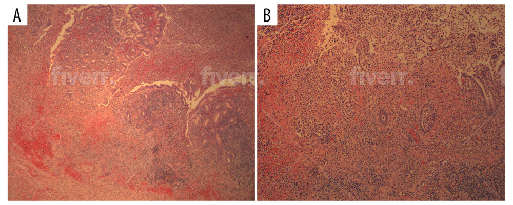 Hematoxylin-eosin-stained histological section showing changes consistent with suppurative appendicitis in (A) 40× and (B) 100× magnifications.