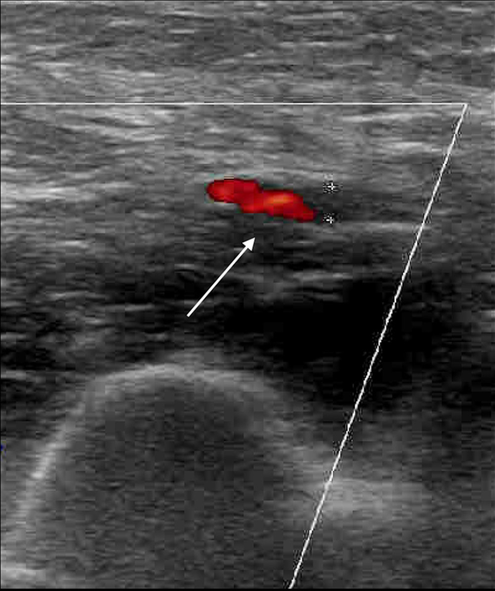 Upper-extremity venous ultrasound revealing an acute occlusive deep vein thrombosis in the right brachial vein (white arrow).