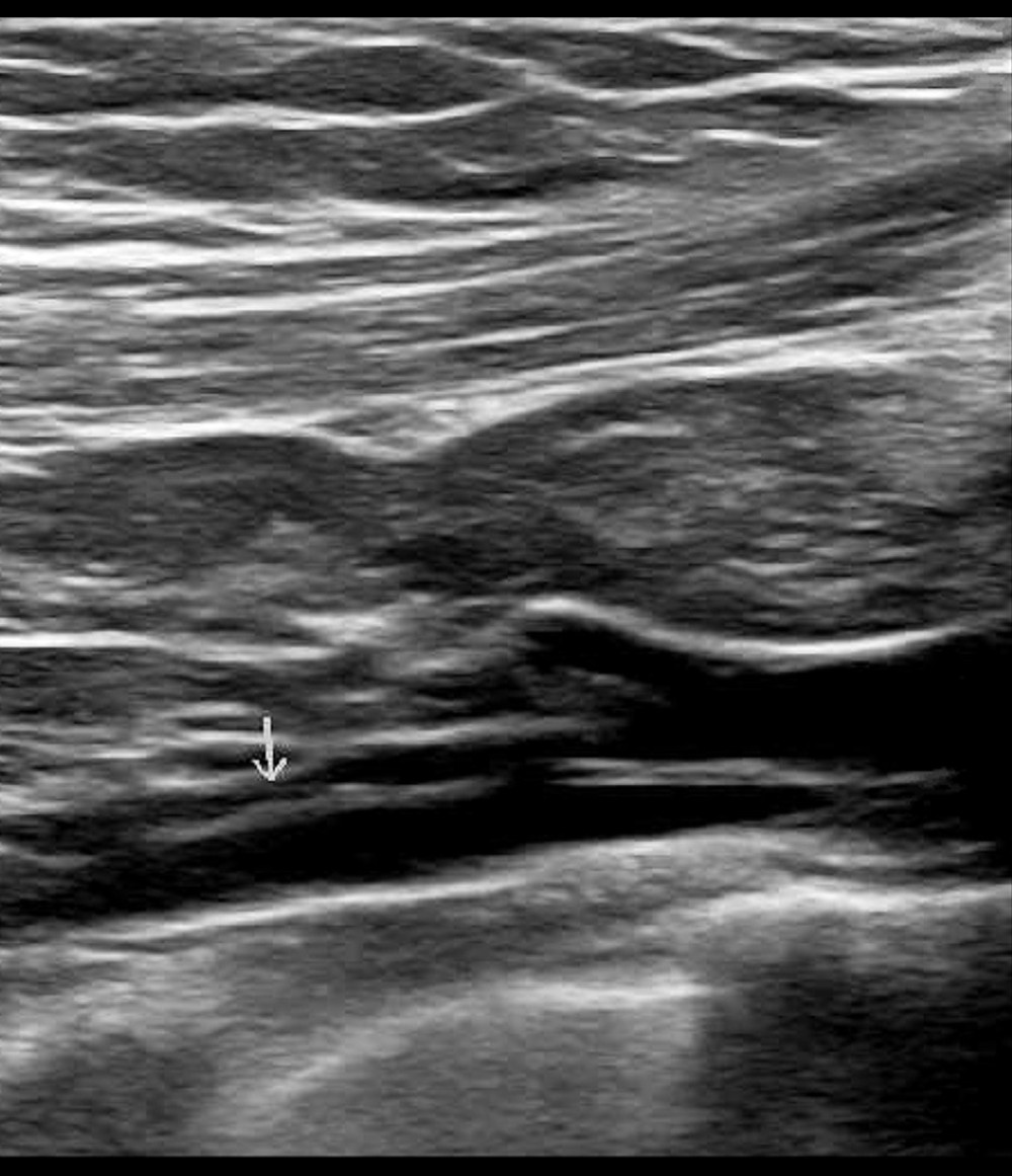 Upper-extremity venous ultrasound revealing a nonocclusive extension of deep vein thrombosis in the right subclavian vein (white arrow).