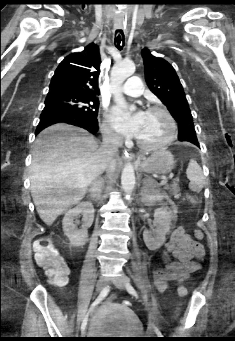 Chest computed tomography revealing a non-occlusive thrombus in the superior vena cava (white arrow).