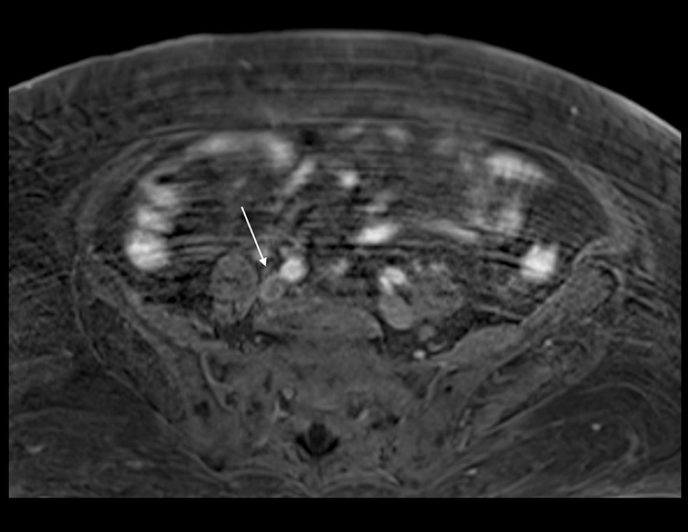 Abdomen magnetic resonance imaging revealing an acute deep vein thromboses in the right common iliac, external iliac, and internal iliac veins (white arrow).