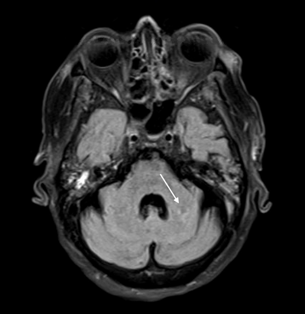 T2 flare brain magnetic resonance imaging revealing a lacunar infarct in the left cerebellar hemisphere (white arrow).