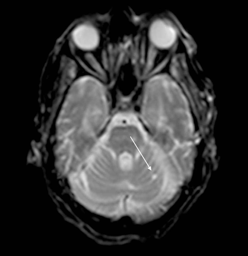 DWI brain magnetic resonance imaging revealing a lacunar infarct in the left cerebellar hemisphere (white arrow).