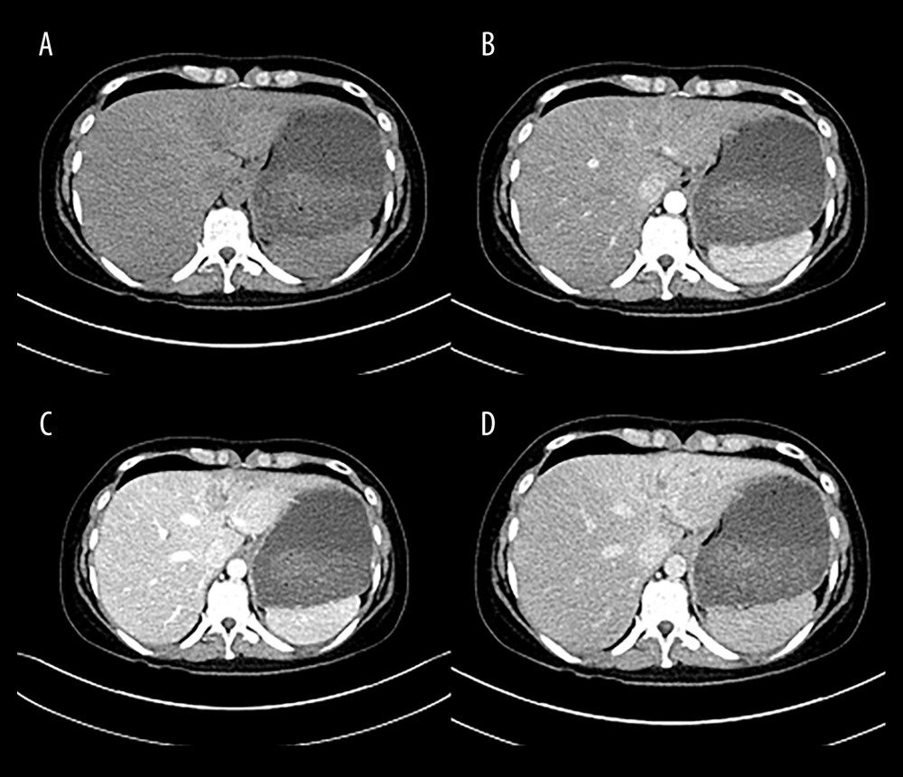 Preoperative computed tomography shows intrahepatic cholangiocarcinoma in left liver. Noncontrast (A), arterial (B), portal venous (C), and delayed phases (D).