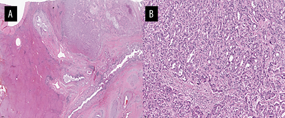 Microscopic features of the tumor. (A) Representative low-power view of the tumor demonstrates invasion to hepatic parenchyma (×20). (B) On high-power examination, the tumor consists of closely packed well-formed or irregularly-shaped glands in a fibrous stroma (×200).