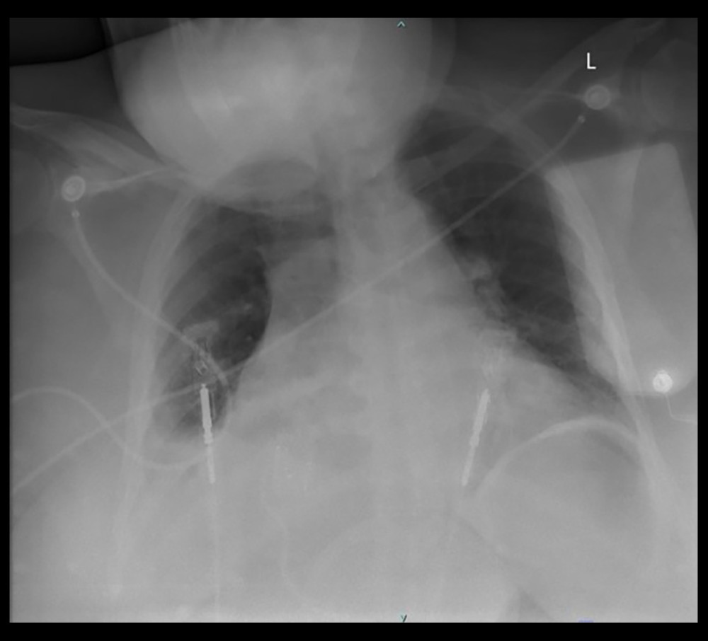 Chest X-ray revealed a small right pleural effusion, with partial right lower lobe atelectasis and cardiomegaly.