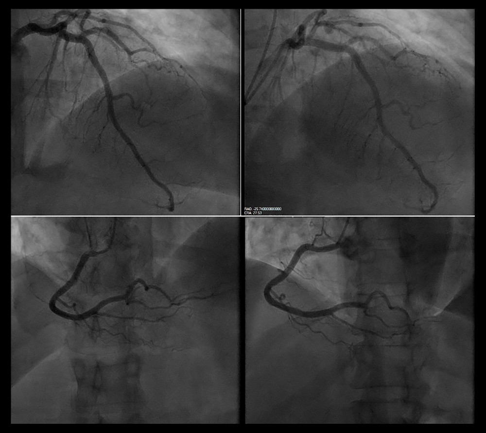 Left heart catheterization images showing no significant coronary artery disease.