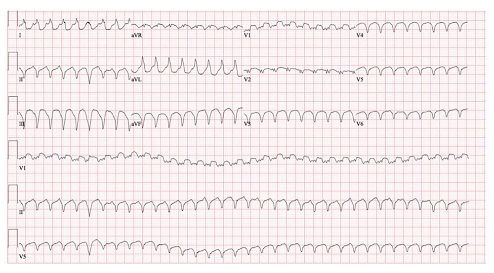 Twelve-lead electrocardiogram showing a wide complex tachycardia with a rate of approximately 200 beats per min, consistent with ventricular tachycardia.