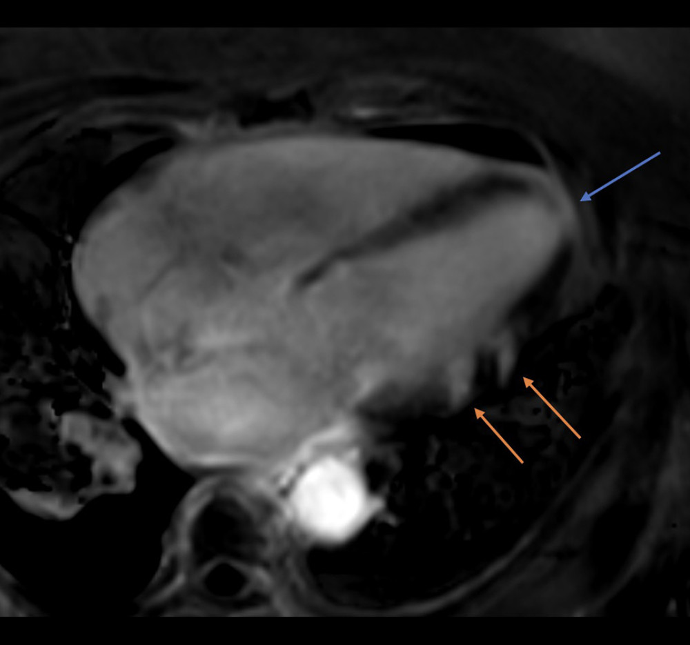 Long-axis 4-chamber phase-sensitive inversion recovery sequence in cardiac magnetic resonance. Findings of late gadolinium enhancement in the mid-lateral wall (subendocardial and mid-myocardium, orange arrows) and apex (subepicardial with adjacent enhancement of pericardium, blue arrows) are shown.