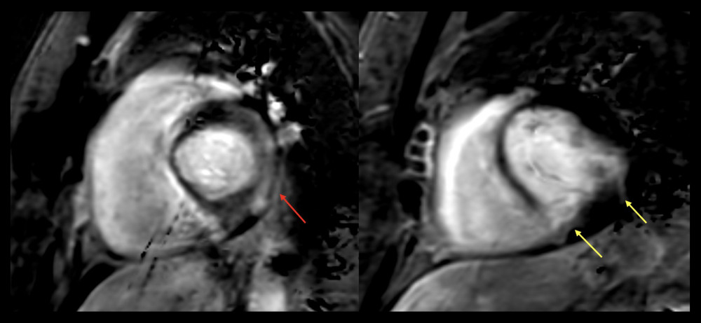 Short-axis phase-sensitive inversion recovery sequence in cardiac magnetic resonance (CMR). Findings of late gadolinium enhancement (LGE) in the lateral wall or mid-myocardium (image A, red arrow) are shown. Similar findings are shown of LGE in the lateral wall (subendocardial and midmyocardial) and posterior right ventricle insertion (transmural) (image B, yellow arrows).